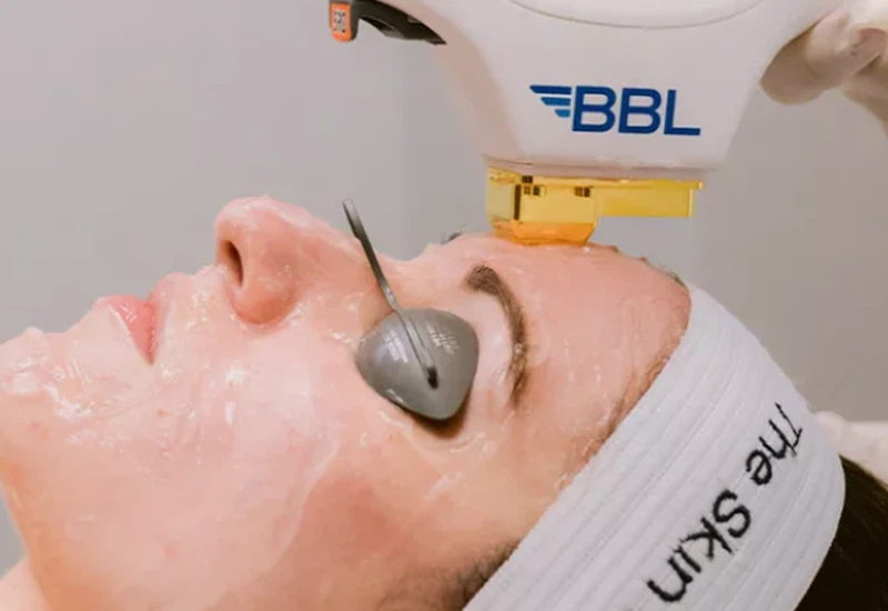 BBL Laser Treatment BBL Laser Treatment
